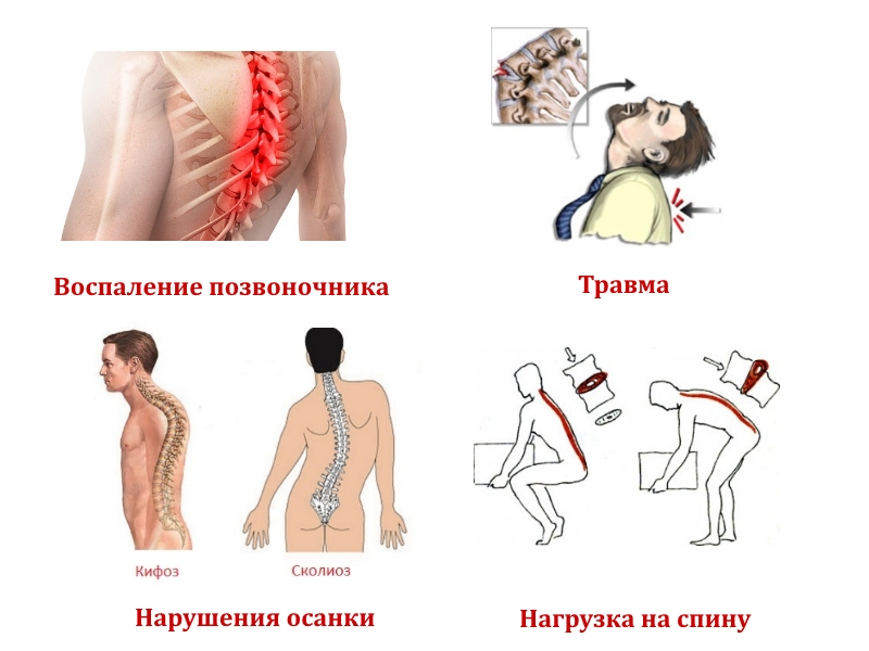 Причины гемангиолипомы позвоночника