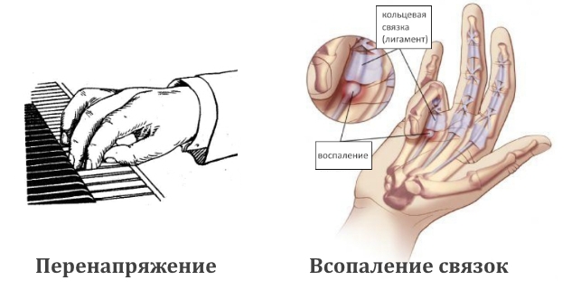 Причины гигромы на ладони