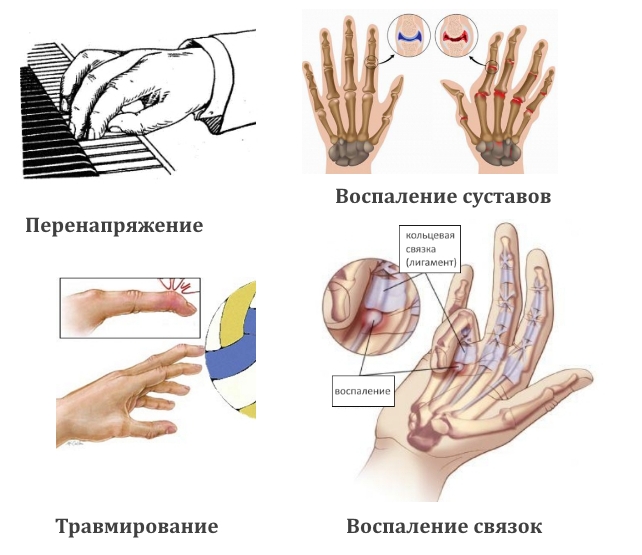 Причины гигромы пальца руки