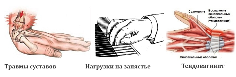 Причины развития гигромы запястья