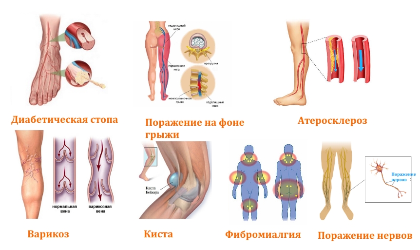 Причины онемения ног в голени