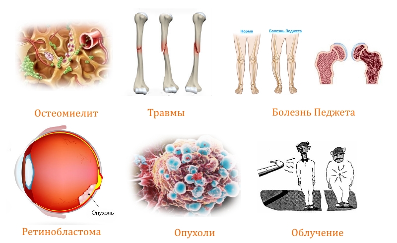 Причины остеосаркомы