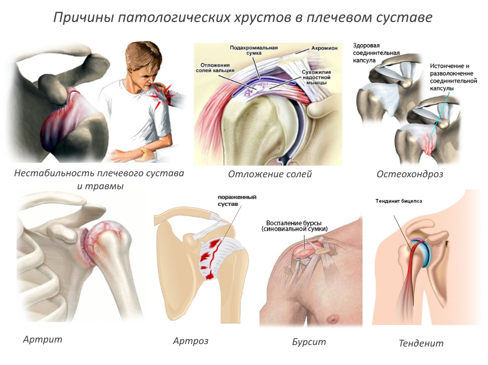 Причины патологических хрустов в плечевом суставе