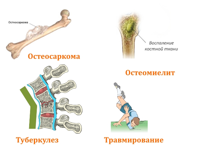 Причины перелома ключицы