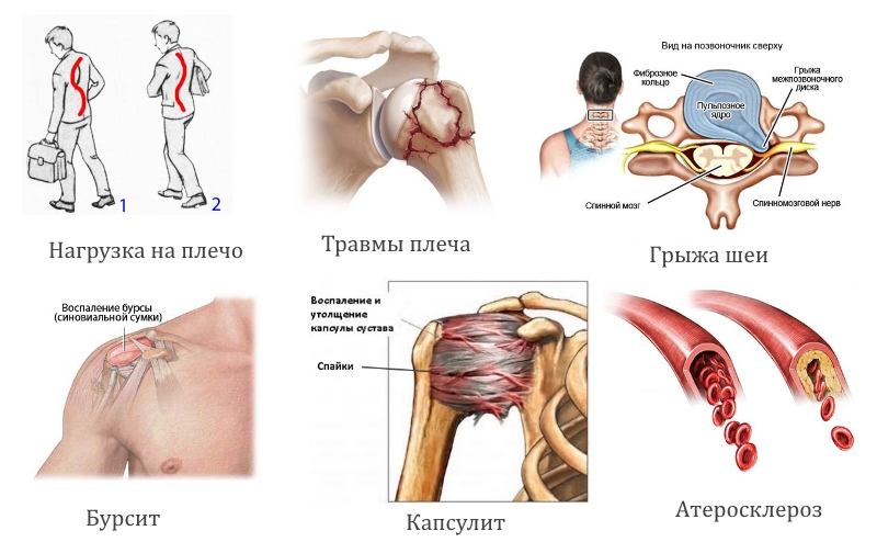 Причины периартроза плеча