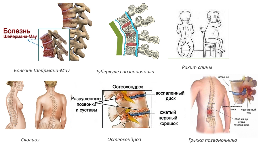 Причины поясничного кифоза