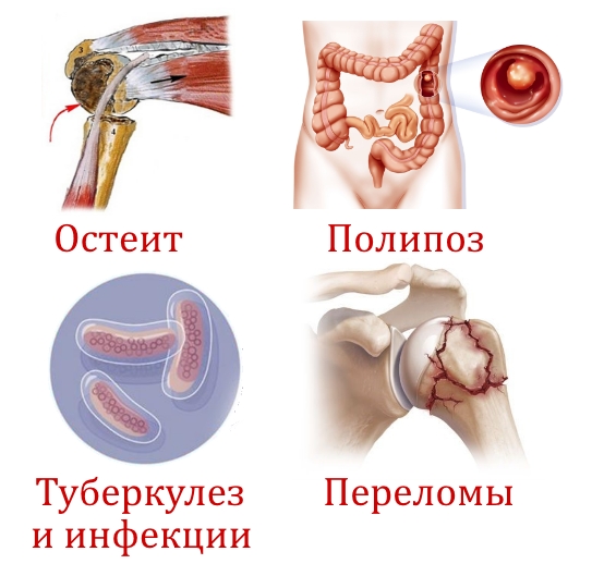 Причины появления саркомы