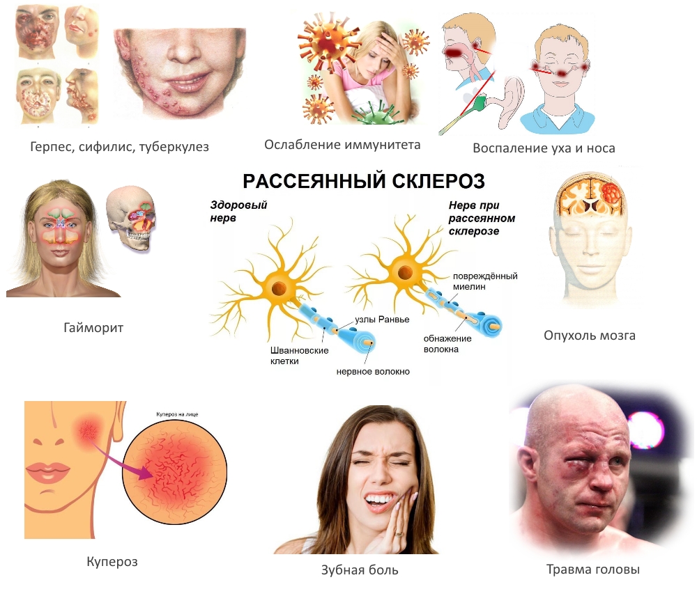 Причины защемления тройничного нерва