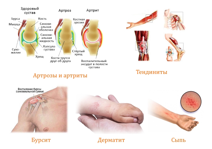 Применение Дипроспана