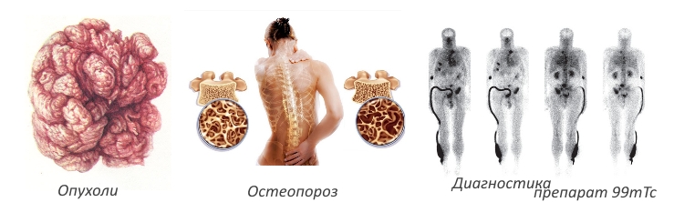 Применение Золедроновой кислоты