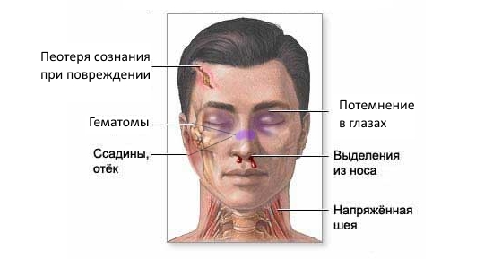 Признаки сильного ушиба носа