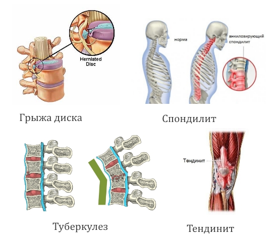 Противопоказания для парилки