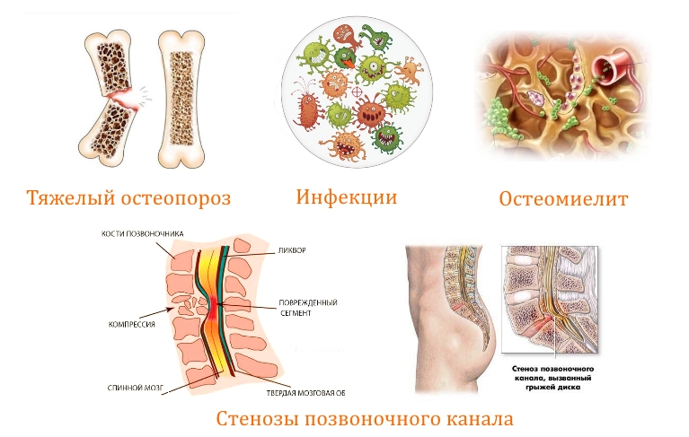 Противопоказания к вертебропластике
