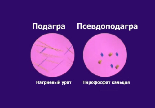 Отличие подагры и псевдоподагры