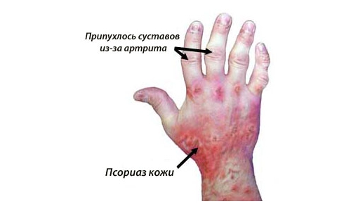 Псориатический артрит