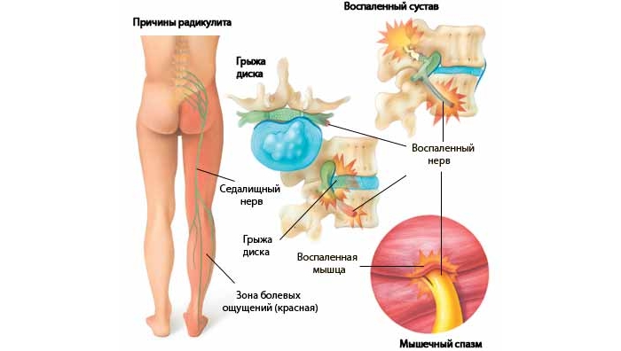 Радикулит