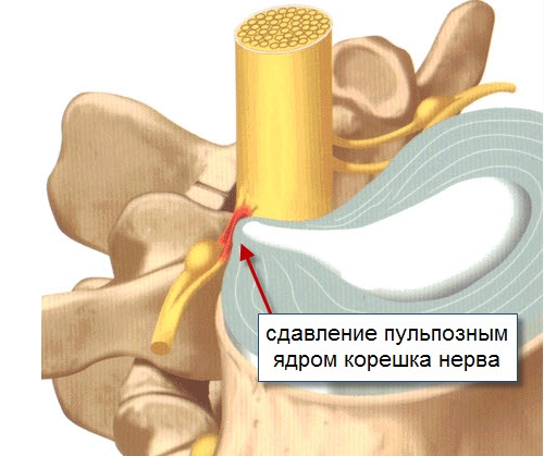 Радикулит позвоночника
