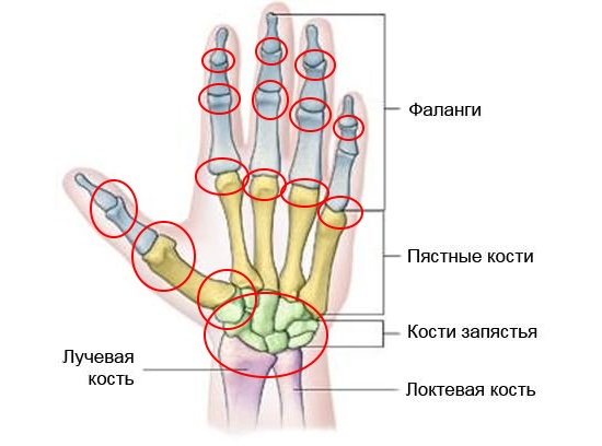 Распространение артроза пальцев рук