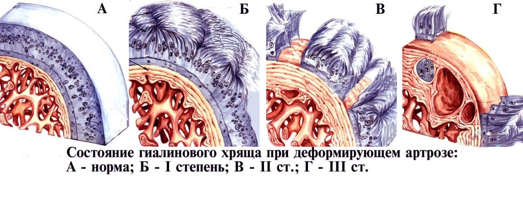 Разрушение хряща при артрозе