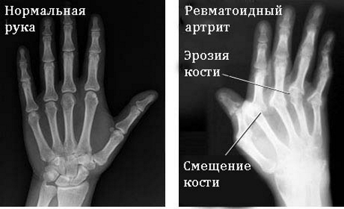 Ревматоидный артрит на рентгене