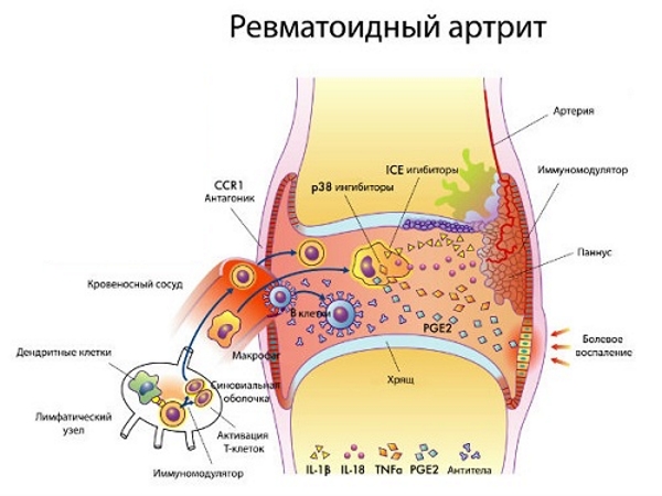 Ревматоидный артрит