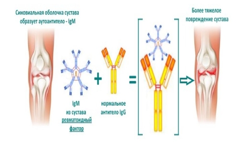 Возникновение ревматоидного артрита
