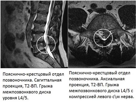 Сакральная киста