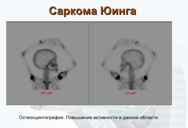 Саркома Юинга
