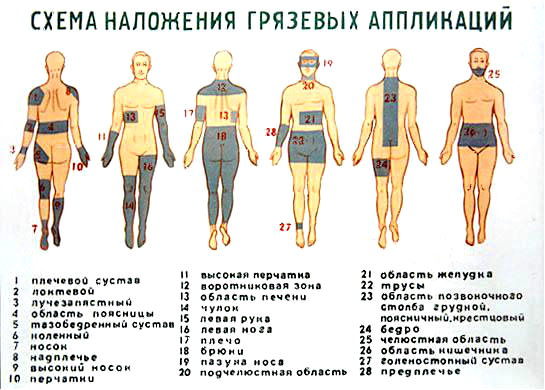Схема наложения лечебной грязи