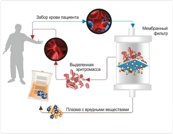 Схема процесса плазмафереза крови