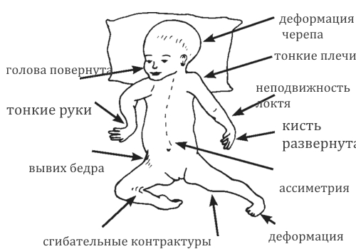 Симптомы Артрогрипоза