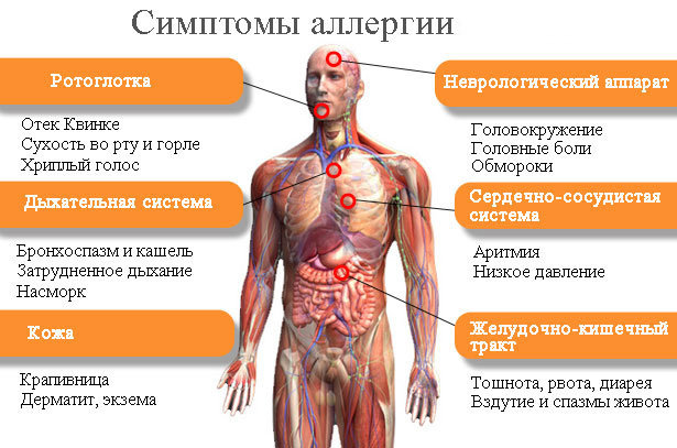 Симптомы аллергии