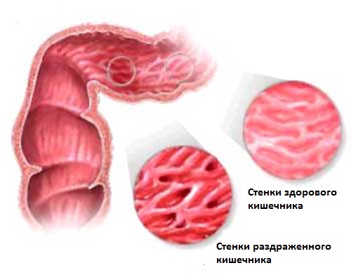 Синдром раздраженного кишечника