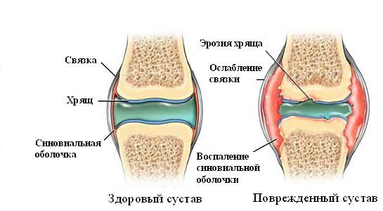 Повреждение сустава при синовите