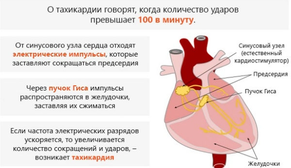 Синусовая тахикардия сердца
