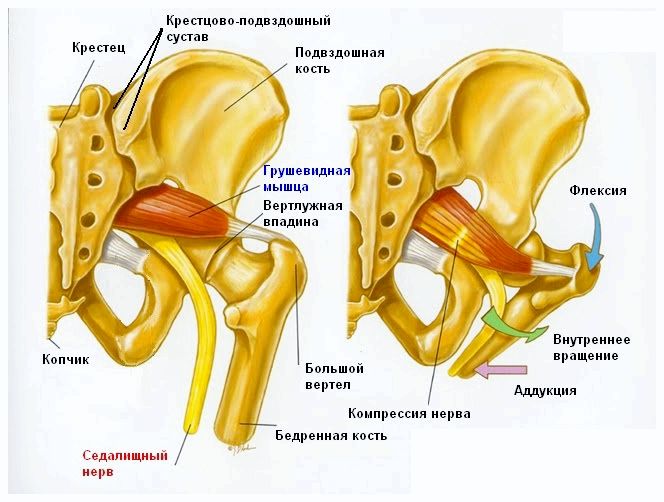 Синдром грушевидной мышцы