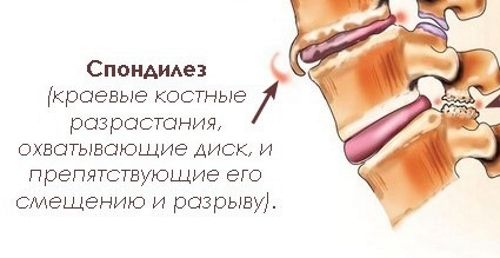 Спондилез 