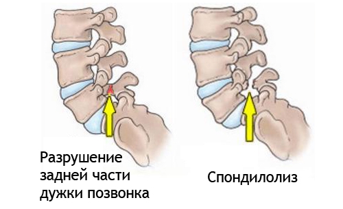 Спондилолиз