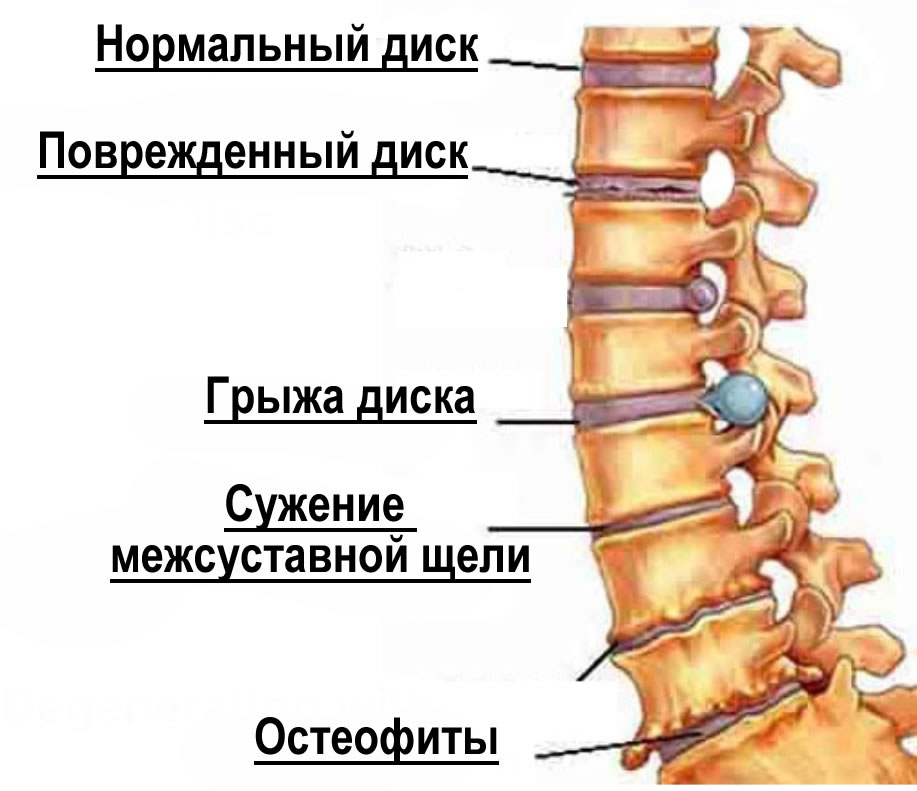 Стадии остеохондроза