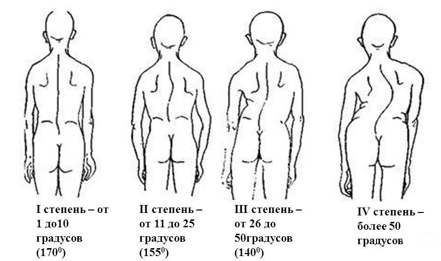 Стадии сколиоза