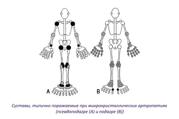 Суставы, типично поражаемые при подагре и псевдоподагре