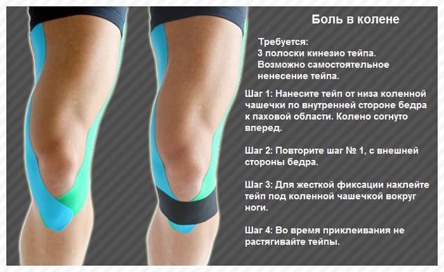 Тейпирование при боли в колене