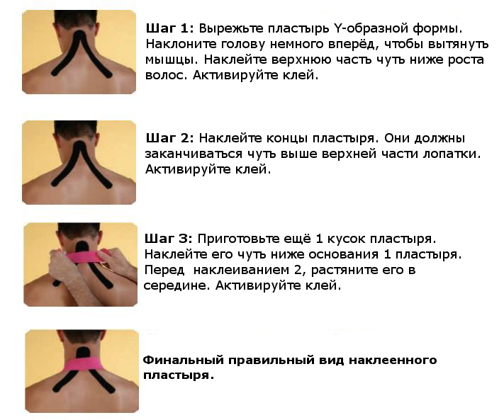 Тейпирование при боли в шейном отделе