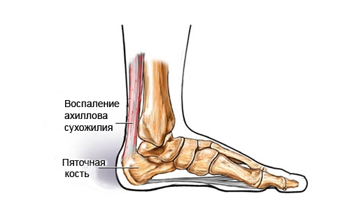 Тендинит ахиллова сухожилия