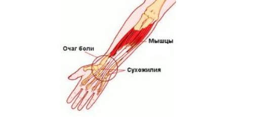 Тендиноз запястья