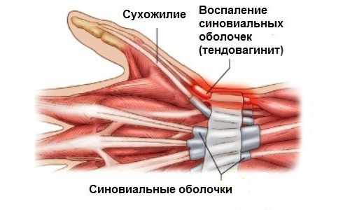Тендовагинит