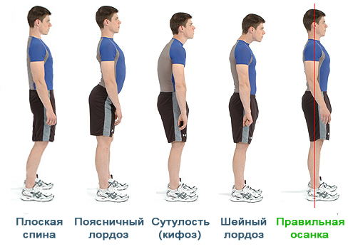 Типы осанки при лордозе
