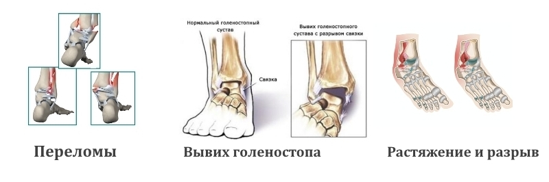 Травмы голеностопа