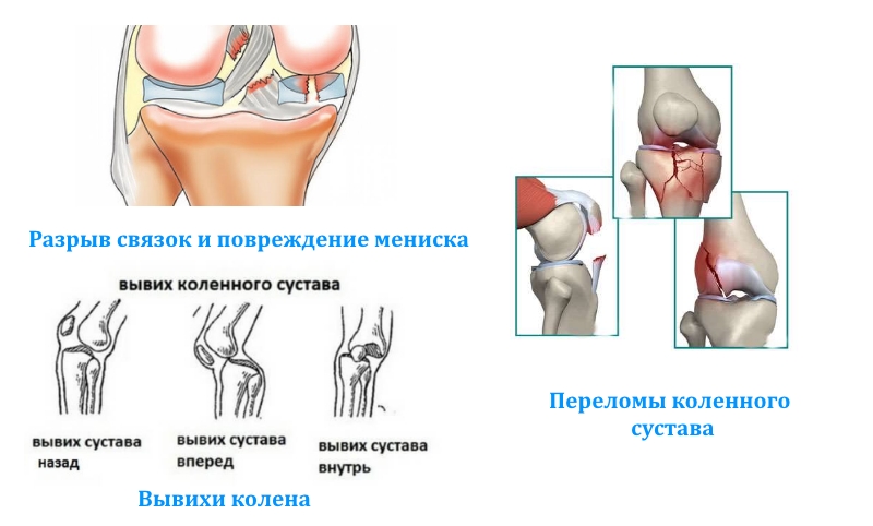 Травмы колена