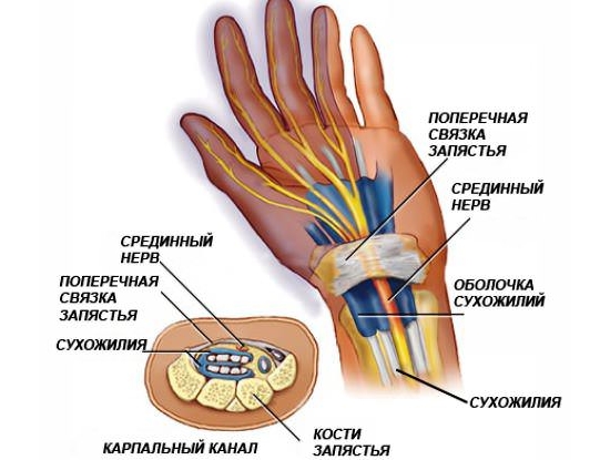 Туннельный синдром запястья кисти